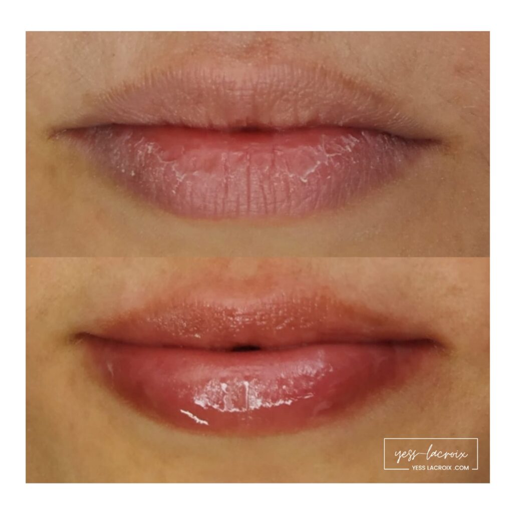cambios Curso Online Dermapen y BB Lips