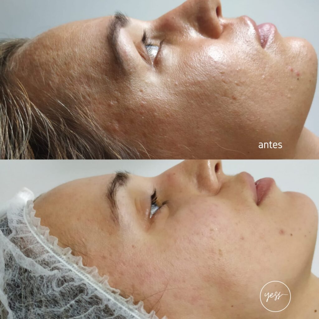 cambios La guía definitiva para el Dermapen